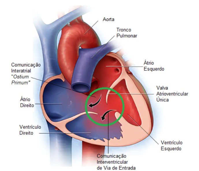 Defeito do Septo Atrioventricular (DSAV) - Dr. João Luiz Manica